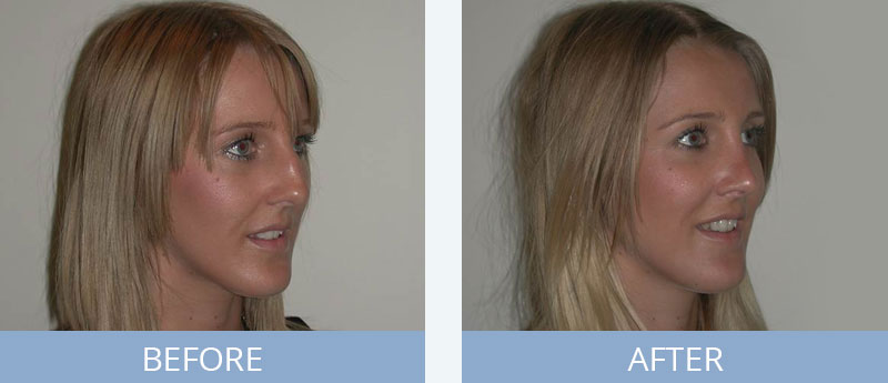 Rhinoplasty Before and After 1