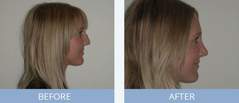 Rhinoplasty Before and After Side