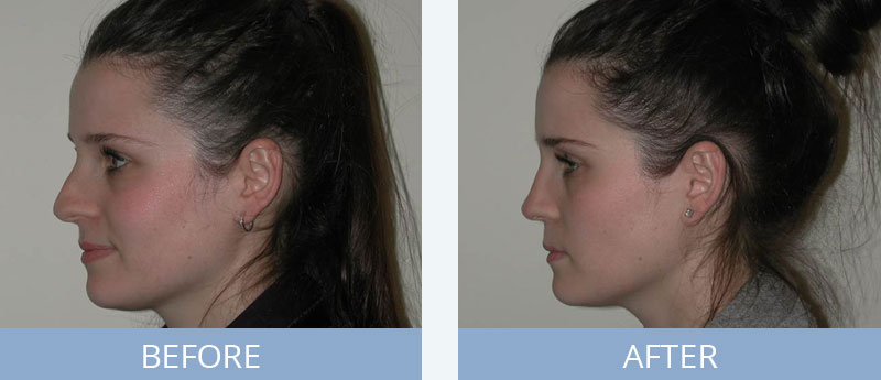 Rhinoplasty Surgery Before and After
