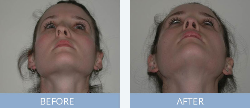Rhinoplasty Before and After Closeup