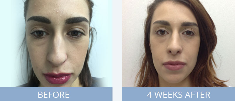 After Rhinoplasty Nose Surgery