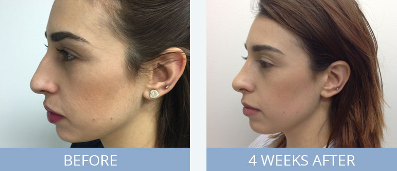 Close Up Look Rhinoplasty After Surgery